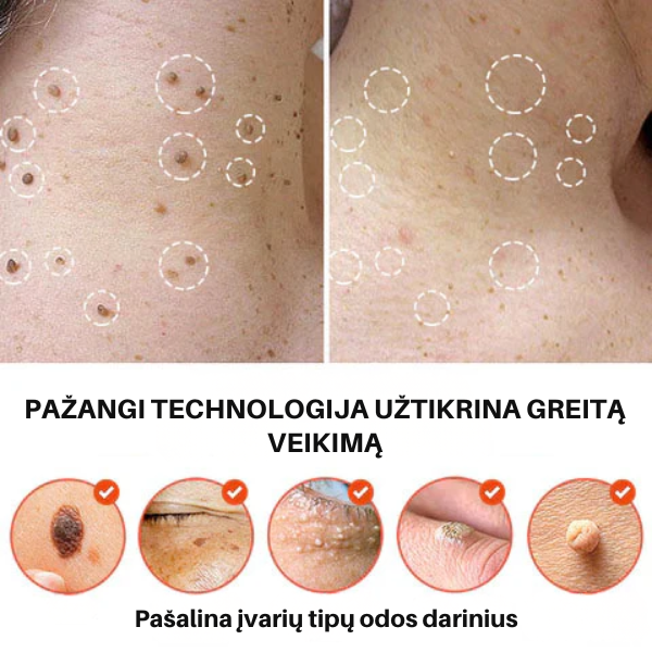 Efektyvūs ir pažangūs pleistrai spuogams ir karpoms šalinti
