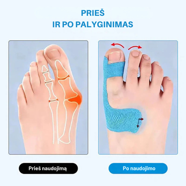 Kineziterapinė juosta hallux valgus korekcijai ir gydymui